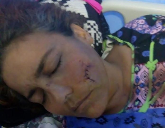 Lisbeth González es una mujer wayuu que resultó herida en la cara con un perdigón durante una manifestación. (Foto: Cortesía familia González).